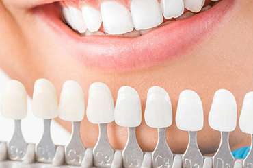 Porcelain Veneers