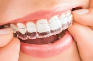 Invisalign